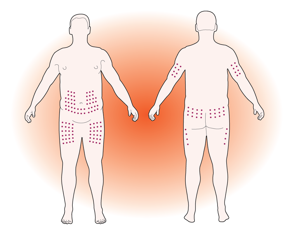 A animated pictures of recommended places for injection.