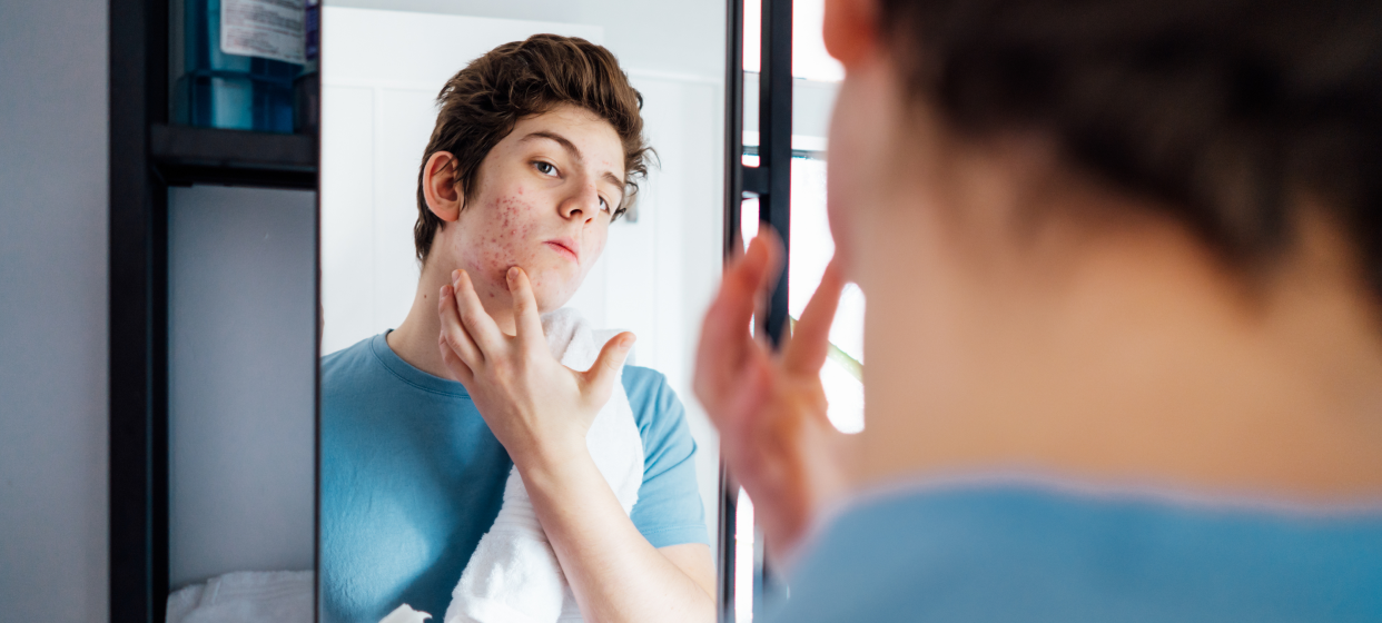 A boy looks at his reflection in a mirror, examining his face closely with a worried expression as he notices acne on his skin